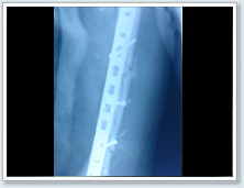 Orthopaedic Surgery delhi