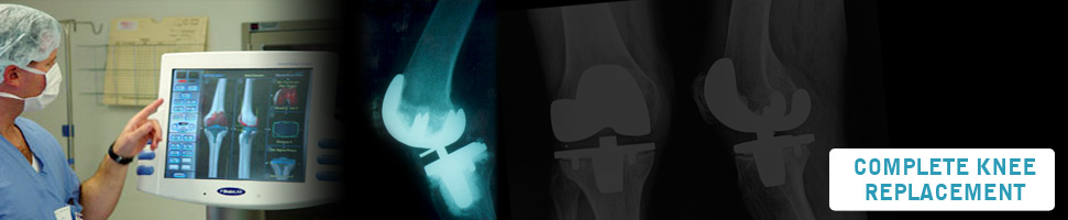 Complete Knee Replacement