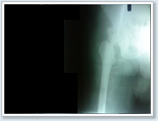 Orthopaedic Surgery delhi